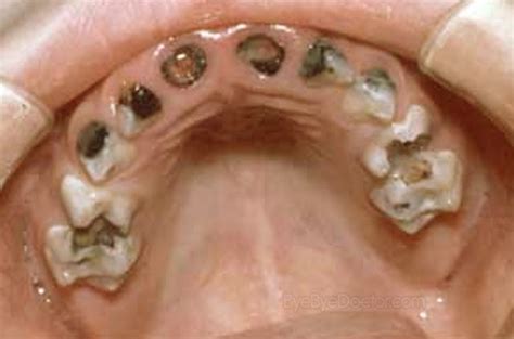 Tooth Decay – Symptoms, Causes, Treatment, Pictures | Symptoms Causes Treatment and Prevention ...