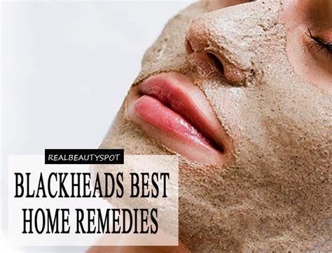 Blackheads: Causes and best Home-Remedies - THE INDIAN SPOT