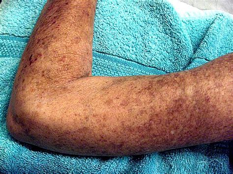 Scleroderma - Wikipedia