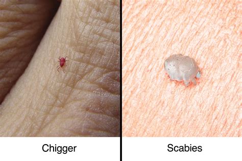 Chigger Bites vs. Scabies: How to Tell the Difference | The Healthy