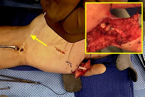 A-2 PULLEY RUPTURE (FLEXOR TENDON SHEATH RUPTURE) | Hand Surgery Resource