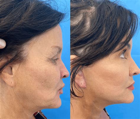 Safelift Mini-Facelift | Cosmetic & General Dermatology in Fort Worth, Dallas and Cleburne, TX ...