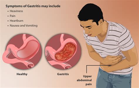 Gastritis symptoms, diagnosis, complications, and treatment