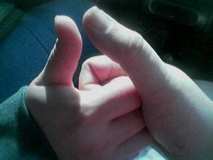 How to treat a jammed thumb | Injuries, Fractures and Burns articles ...