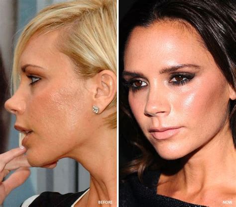 8 Celebrities Who Fixed Their Skin Problems