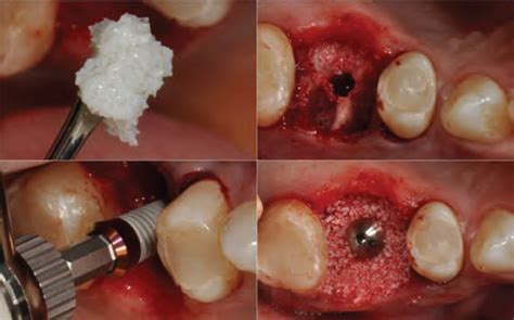 Immediate implant placement in fresh extraction sockets using the open ...