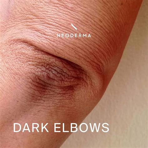 Dark Elbows – NEODERMA