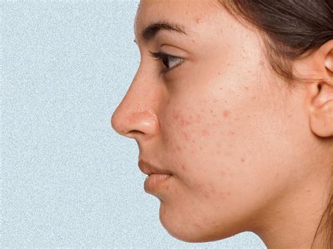 Acne – A Common Problem, Its Causes And Cure | Elite by Esente - Articles