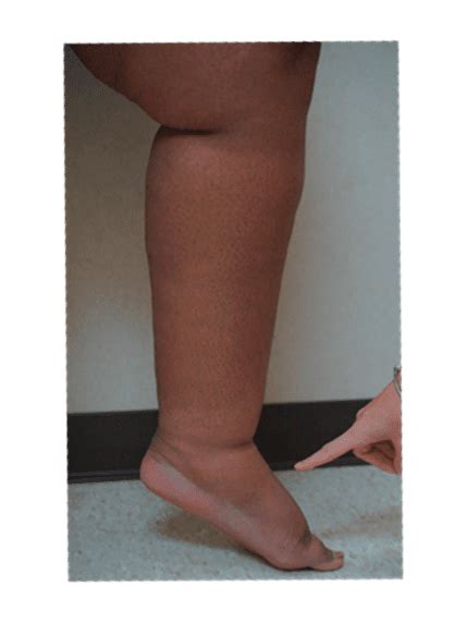 Lymphedema Specialist - Memphis, TN: Kishore K. Arcot , MD, FACC, FSCAI ...