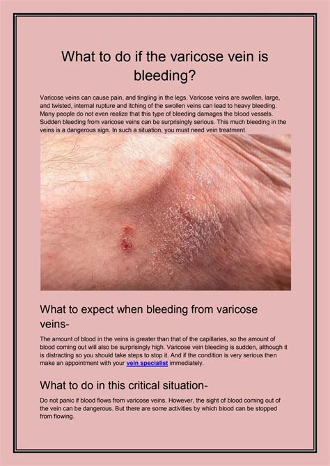 What to do if the varicose vein is bleeding? by andrewhadleys - Issuu