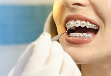 The Importance of Adult Orthodontics Treatment for a Healthy Smile – Redcolombiana