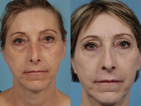 Eyelid Surgery (Blepharoplasty) in Chicago | Dr. Thomas Mustoe & Dr. Sammy Sinno