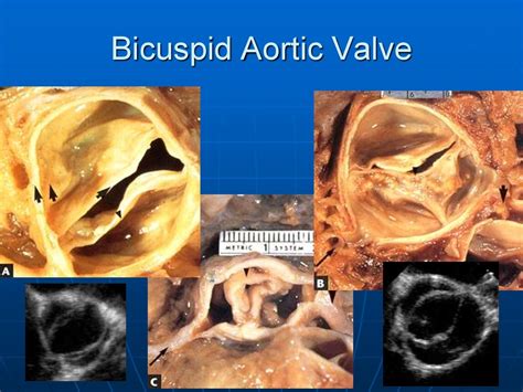 Aortic Stenosis Online Presentation | Free Nude Porn Photos