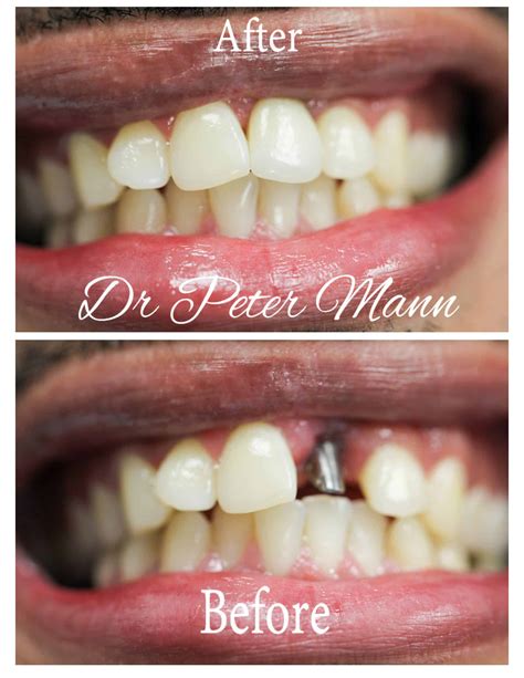 Tooth Implant Before After