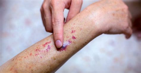 Purpuric Rash Causes, Pictures, and When to Get Medical Help