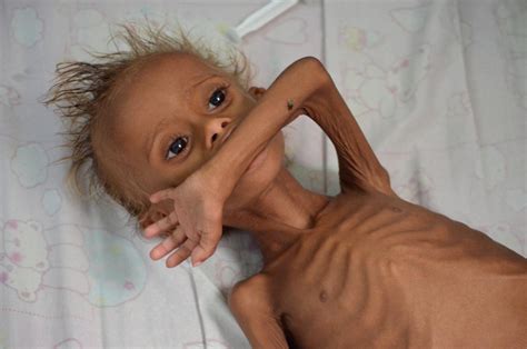 Starving children of Yemen