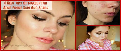 8 Best Tips Of Makeup For Acne Prone Skin And Scars