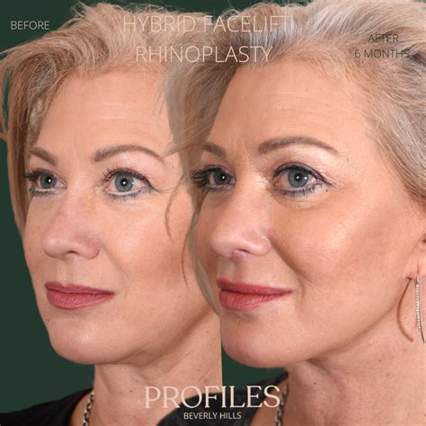 Best Facelift Surgeon Los Angeles | Facelift Beverly Hills