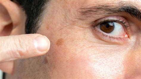Common Dark Spots on the Face | Advanced Dermatology of the Midlands