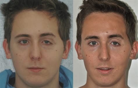 Remarkable Facial Reconstruction Surgery - MEDizzy Journal