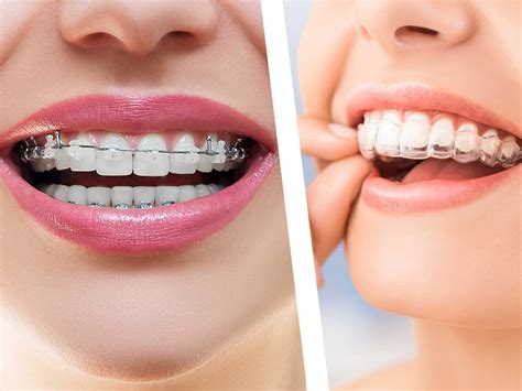 Which one is better: Invisalign or Braces?