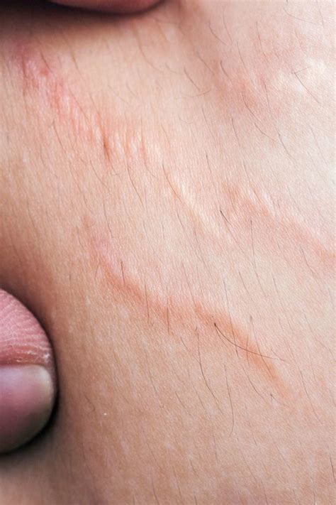 Stretch marks on thighs: Appearance, causes, and treatments