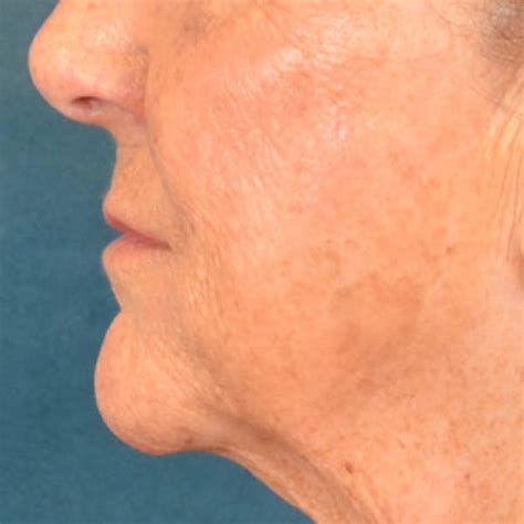 Patient 139841 | Lip Lift Before & After Photos | Starkman Facial ...