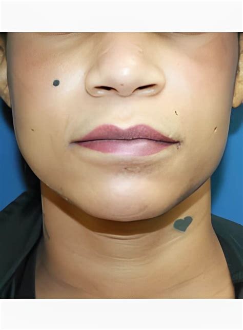 Cheiloplasty (Lip Reduction) Gallery | Before & After