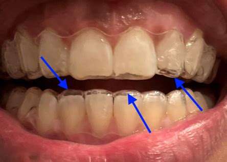 The "Secret Sauce" of Clear Aligner Therapy - Strayt