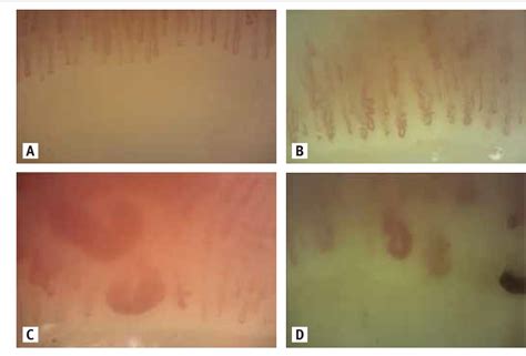 Figure 1 from Nailfold Capillaroscopy Patterns. | Semantic Scholar