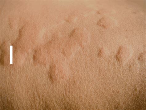 Worst pregnancy side effect ever? For me, it's hives | BabyCenter