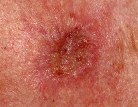 Squamous Cell Carcinoma Skin Cancer Questions Answered » Scary Symptoms