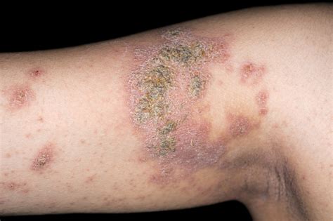 Prevalence of Atopic Dermatitis 7.3% in U.S. Adults - The Clinical Advisor