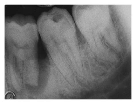 Evaluation of periodontal pocket. | Download Scientific Diagram