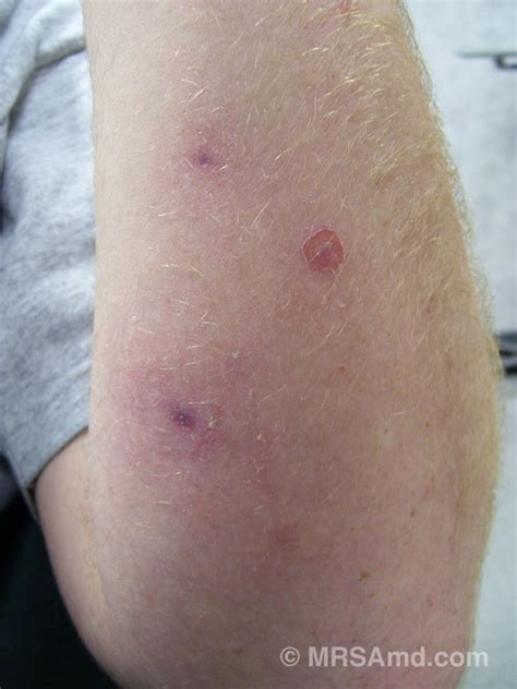 MRSA Pictures / Staph Infection Pictures/Graphic Images – MRSA MD