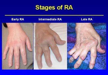 Bodybuilding Can Help You Manage Rheumatoid Arthritis!