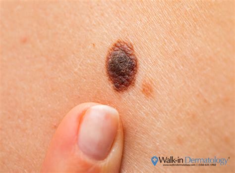 What Happens if you Accidentally Scratch Off a Mole? - Walk-in Dermatology