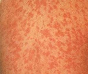 Petechial Rash - Pictures, Symptoms, Causes, Treatment