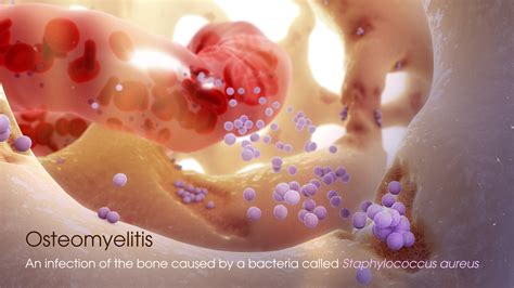 Osteomyelitis (OM): Causes, Symptoms, Risk factors, and Treatment - Scientific Animations