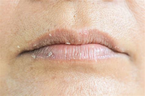 Droge lippen en schil stock foto. Image of dermatitis - 125402634