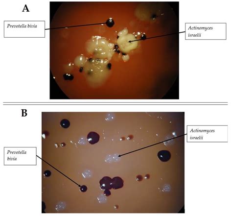 Elucidación luz de sol acumular actinomyces colony morphology vestir ...