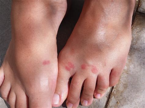 Skeeter Syndrome Mosquito Bite Allergy - Mosquito Bite Allergies Symptoms And Treatment - Aug 04 ...
