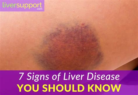 Symptoms of liver disease you should know – Artofit