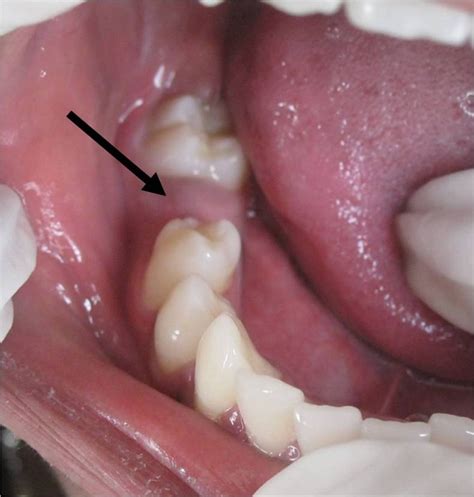 Dentigerous cyst: a common lesion in an uncommon site | BMJ Case Reports