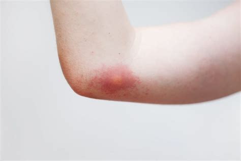What Are the Symptoms and Treatments of Wasp Stings? - Facty Health