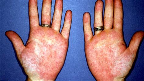 Mi az a Palmar Erythema? - Orvos 24