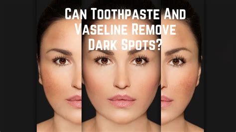 Can Toothpaste And Vaseline Remove Dark Spots? - Power Tooth Paste