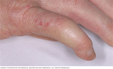 Limited scleroderma - Symptoms and causes - Mayo Clinic