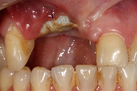 Dental Bone Graft Failure - Dental News Network