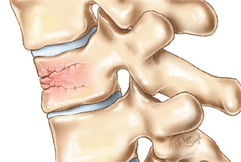 Traumatic Spine Fracture - Goodman Campbell